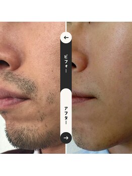 ジュゴン(Dugong)/髭脱毛（Before＆After）