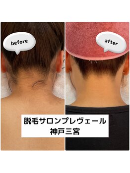 プレヴェール 神戸三宮/後ろ姿美人 うなじ脱毛