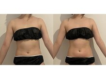 ウェルフォーセルフ(WELL FOR SELF)/キャビテーション×ラジオ波