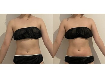 ウェルフォーセルフ(WELL FOR SELF)/キャビテーション×ラジオ波