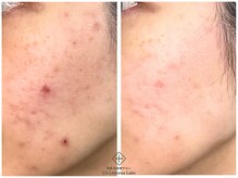 アンレミューラボ(Un Lemieux Labo)/ニキビ、跡改善