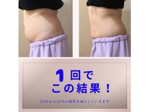 スリム(SLIM by lily of the valley)の雰囲気（長年悩んだ細くなりにくい部分も、脂肪冷却で撃退！）
