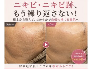 アロマ(AROMA)の写真/スペシャルケア【凹凸ニキビや開き毛穴に速攻アプローチ】剥離なし◎ダウンタイムなし◎施術後ツヤ肌実感◎