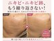アロマ(AROMA)の写真/スペシャルケア【凹凸ニキビや開き毛穴に速攻アプローチ】剥離なし◎ダウンタイムなし◎施術後ツヤ肌実感◎
