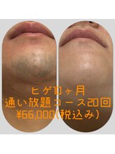 リアンジュ/髭脱毛の経過