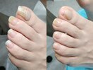 【肥厚・変形爪】ネイル/フット
