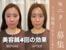 モニター募集（1回あたり6600円）【30本鍼★16カ所電気★45分美容鍼】3回分