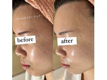 エクレ(eclat)/白玉水光肌♪