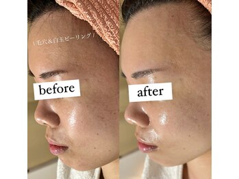 エクレ(eclat)/白玉水光肌♪