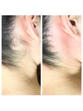 ヴァージン ワックス 渋谷店(Virgin Wax)/【うなじ】ビフォーアフター