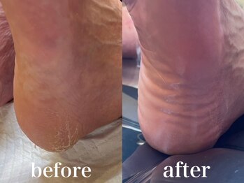 ドクターネイル爪革命 札幌本店/症例紹介26 角質ケア