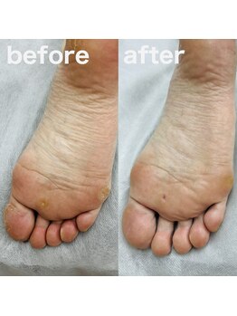 コトリ(Kotori)/【タコ・魚の目ケア】