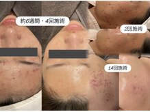 エクラ(eclat)の雰囲気（繰り返すニキビに終止符を。自宅でのケア方法も伝授いたします◎）