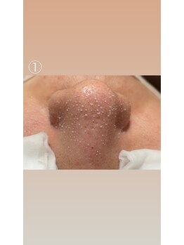 エステサロン桜/小鼻のザラツキ、サヨウナラ！