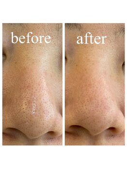 ルナ エスコンディーテ(Luna Escondite)/☆超音波毛穴ブラシ☆