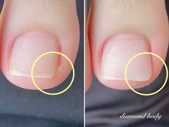 トラブルネイル