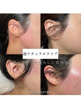 ホテルアンドパーク(HOTEL&PARK.)/もみあげワックス脱毛Mizuki施術