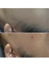 シャンティ(Shanti)/フェイシャルワックス脱毛