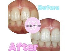 エクシアホワイトニング 泉中央店/ホワイトニングフォーアフター