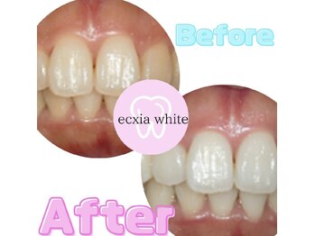 エクシアホワイトニング 泉中央店/ホワイトニングフォーアフター