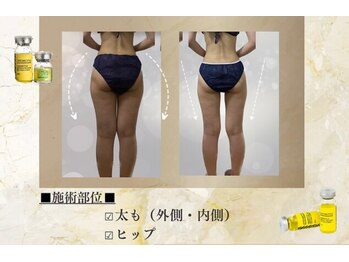 ブレア(Blair)/痩身