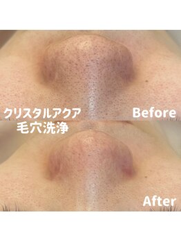 ブルームーン(BLUE MOON)/毛穴ケア