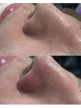 ジュディ サロン(JEUDI SALON)/毛穴汚れ気になりませんか?