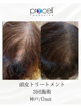 ユミト(Umit)/プロセルスカルプ