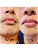 グランデ(GRANDE)/【ヒゲ】ビフォーアフター