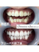ホワイトニングサロン 京都烏丸店/ホワイトニングサロン施術例
