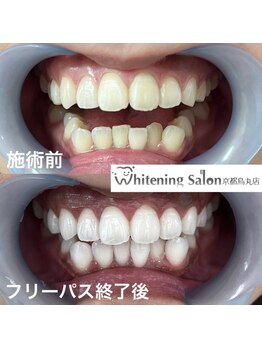 ホワイトニングサロン 京都烏丸店/ホワイトニングサロン施術例