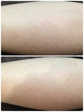 ダブルオー 銀座(00)/美容電気脱毛/脚脱毛