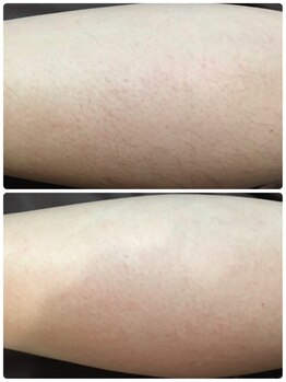 ダブルオー 銀座(00)/美容電気脱毛/脚脱毛