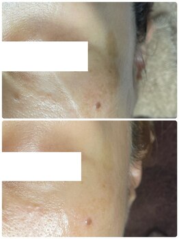 ティエラ(TIERRA)/シミケア3回