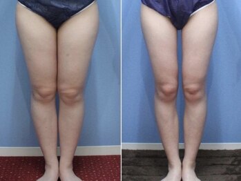 エピア 豊田店(Epia)/☆自力では難しい下半身痩せ☆