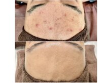 アンナチュラル 錦糸町店(ennatural)/ハーブピーリング