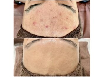 アンナチュラル 錦糸町店(ennatural)/ハーブピーリング