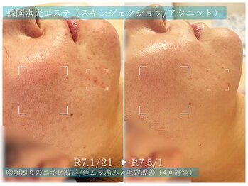 ラ ドゥーサ(La Dusa)/ニキビ改善にスキンジェクション