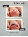 【巻き爪ケア】施術直後その1 右