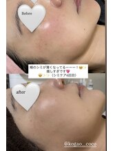 ココ(COCO)/シミケア、ビフォー、アフター