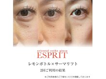 エスプリ 銀座店の雰囲気（目の下のたるみ改善・ほうれい線ケアももレモンボトルならOK!）