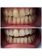 グリッター ショウナン(glitter. SHONAN)/藤沢ホワイトニングbefore/after