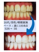 スマイルホワイト 赤羽店/ホワイトニングBefore After