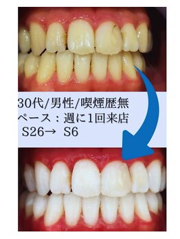 スマイルホワイト 赤羽店/ホワイトニングBefore After