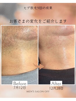 オフ(off)/ヒゲ脱毛