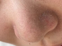 ウミ(Ummi)/角栓をしっかりふやかします