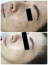 メイユール(MEILLEUR)/光フェイシャル6回