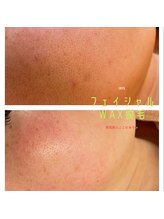アイリス(Iris)/《before→after》お顔のWAX