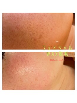 アイリス(Iris)/《before→after》お顔のWAX
