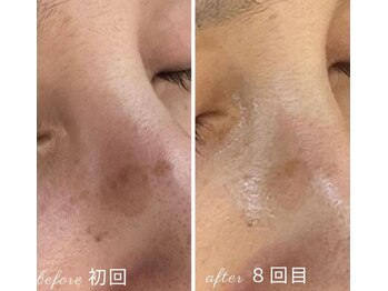 エースマイルイズ(A smile is..)/オセロでシミケア【シミ改善】